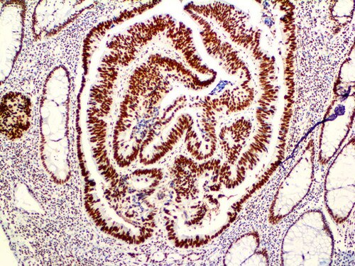 IHC of MSH2 on a Colon Carcinoma